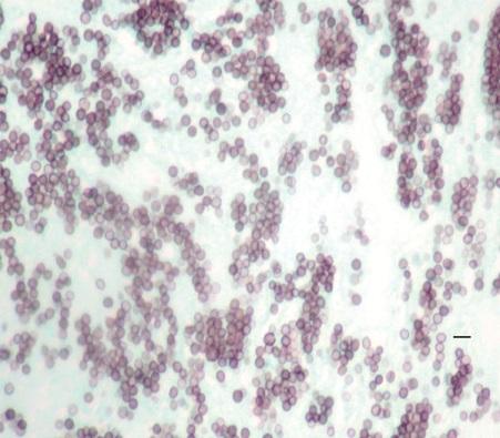 Emergomyces canadensis, a Dimorphic Fungus Causing Fatal Systemic Human