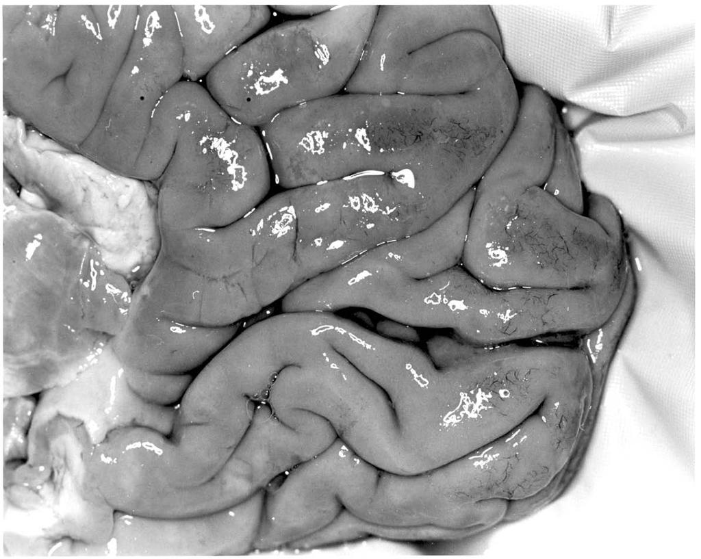 Right occipital lobe from a 79-year-old
