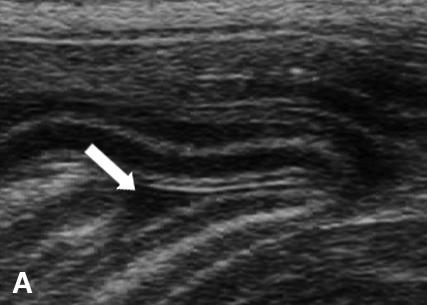 1 Ultrasonographic findings A mild amount of anechoic free peritoneal fluid was observed in all puppies and was most frequently seen as a