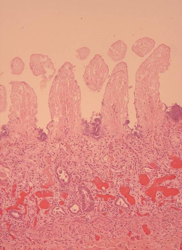 complete crypt loss. The denuded mucosa was extensively colonised by filamentous bacteria. A B FIGURE 14. Histopathology sections of a jejunum affected by canine parvoviral enteritis.