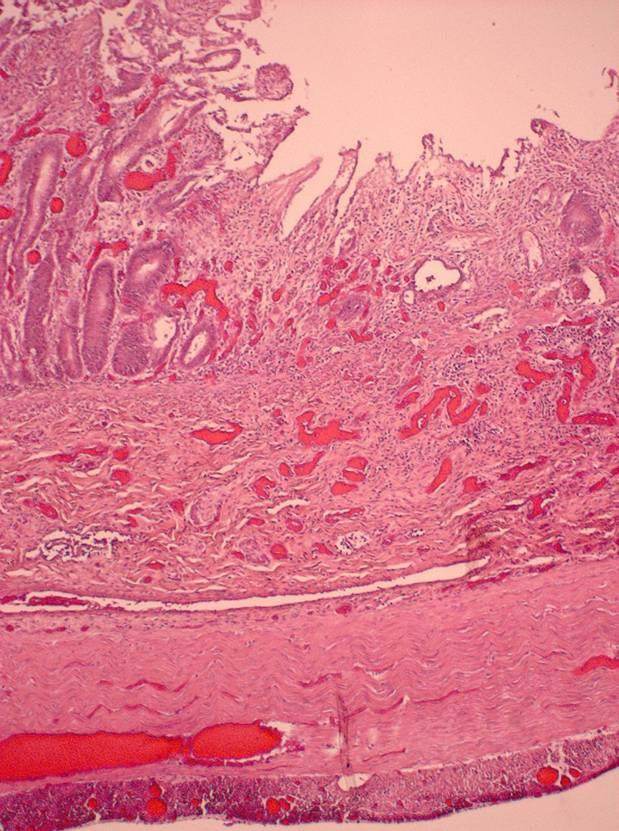 The rest of the mucosa appeared to be sloughing off strands of enterocytes. Puppy 2 Less marked villous collapse and crypt epithelial necrosis than noted in the duodenum and jejunum.