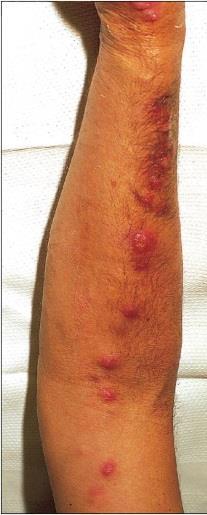 Sporotrichosis o Hand or arm primary site of involvement Trunk, legs and face can also be infected o Chronic ulceration occurs at site of wound o Development of ulcerating nodules Develop