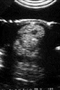 Ultrasound (Sonography) This non-invasive procedure uses ultrasonic waves to image