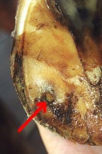 Foot Abscess An accumulation of purulent exudate (pus) in the foot, most commonly under the
