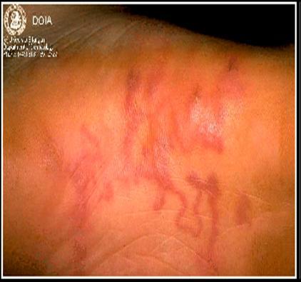 CLM (Original image from and copyrighted by Dermatology