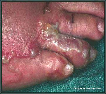 (Original image from and copyrighted by Dermatologic Image Database,