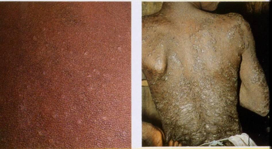 Onchocerciasis: Elephant or Lizard skin and