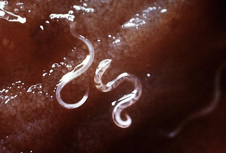 What does the hookworm look like? HOOKWORM infection More Information: 1.Brooker S, Bethony J, Hotez PJ. Human hookworm infection in the 21