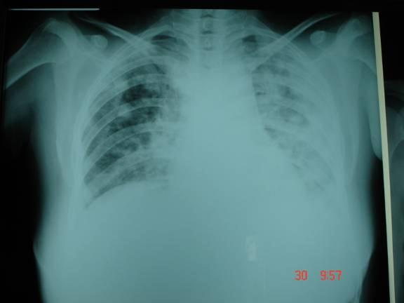Case 4 40 y/o man Prey Veng History DMII (3years) Malaria in 1980 Liver abscess (4 & 2 months ago)