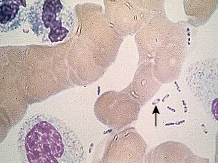 Diagnosis Culture and staining Specimens: bubo aspirate, sputum, blood Blood culture: positive in 27 to 96 % patients Bubo