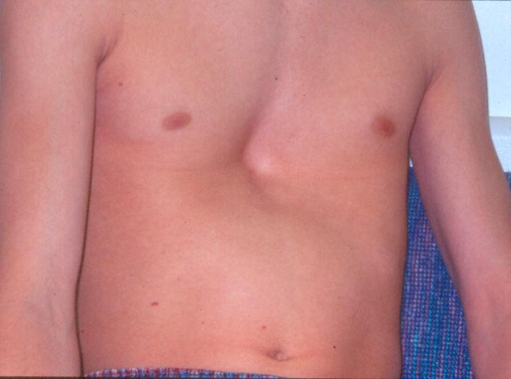 PECTUS EXCAVATUM May have variations in depth and symmetry Progressive disorder Deformity may be noted at