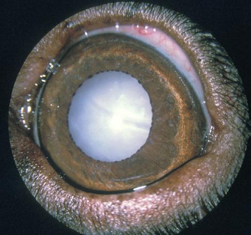 Primary lens luxation (PLL) Primary lens luxation is a condition in which an inherent defect in the zonule (the suspensory ligament of the lens) leads to partial or complete dislocation of the lens