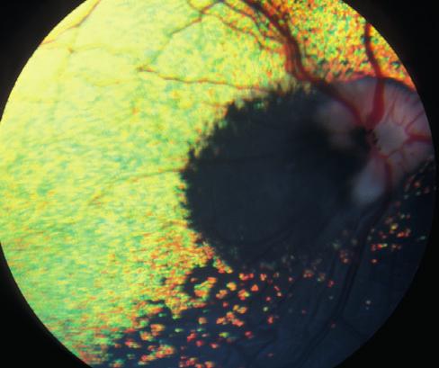 94:Border Collie inactive focal chorioretinopathy lesions (probably ocular larva migrans originally). 95: Systemic hypertensive disease associated with hyperadrenocorticism.