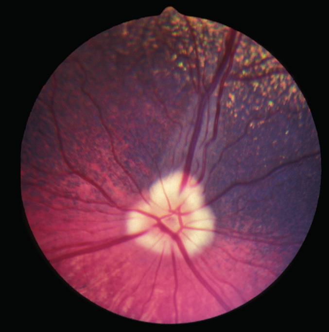 4 5 5: Subalbinotic eye of a normal adult Border Collie.