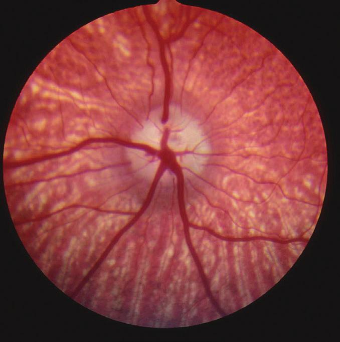 Both retinal and choroidal vessels are visible and there is