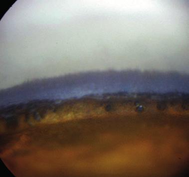 11: Welsh Springer Spaniel chronic closed angle glaucoma with globe enlargement (left eye).
