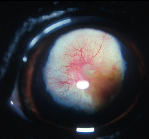 21 22 23 24 21: Persistent hyperplastic primary vitreous in a Dobermann. The white opacity visible through the pupil involves the vitreous and posterior lens capsule.
