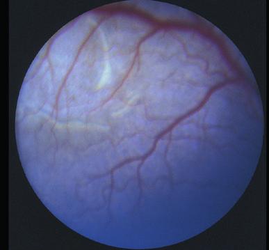 characteristics of multifocal retinal dysplasia.