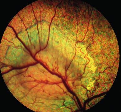 pigment epithelium. Irregularly shaped (geographic) areas of retinal dysplasia may also be encountered. In most cases, the lesions are most obvious in the tapetal fundus dorsal to the optic disc.