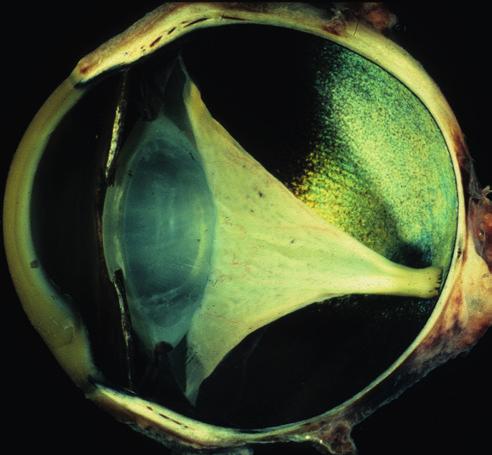 Other ocular defects, such as microphthalmos, nystagmus and cataract, may be present.