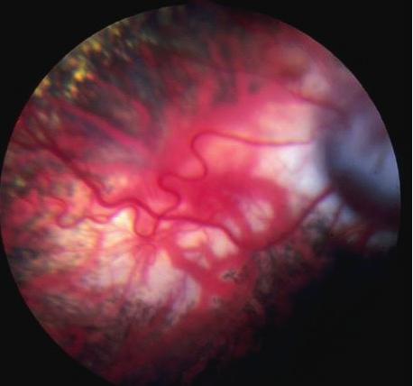 The most striking feature is the peripapillary coloboma ventral to the optic nerve head. 37: Collie eye anomaly in an adult Border Collie.
