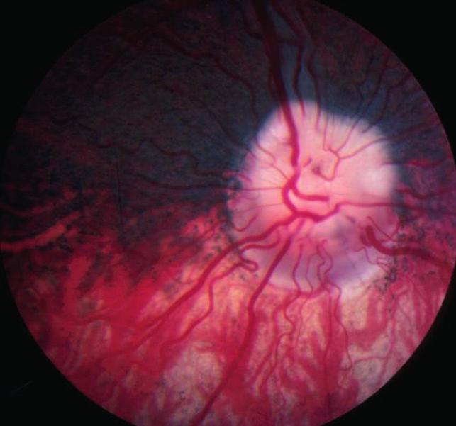 Tortuosity of the retinal vessels and retinal folds, the latter usually in the form of vermiform streaks, are not now regarded as part of the syndrome, but may relate to the smallness of the eye.