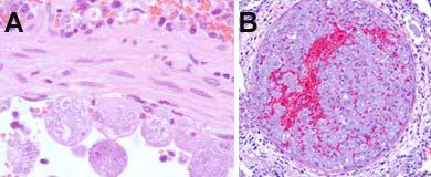 Figure 2B. Widespread parasitic thrombus formation in the acute schizogenous phase of cytauxzoonosis.