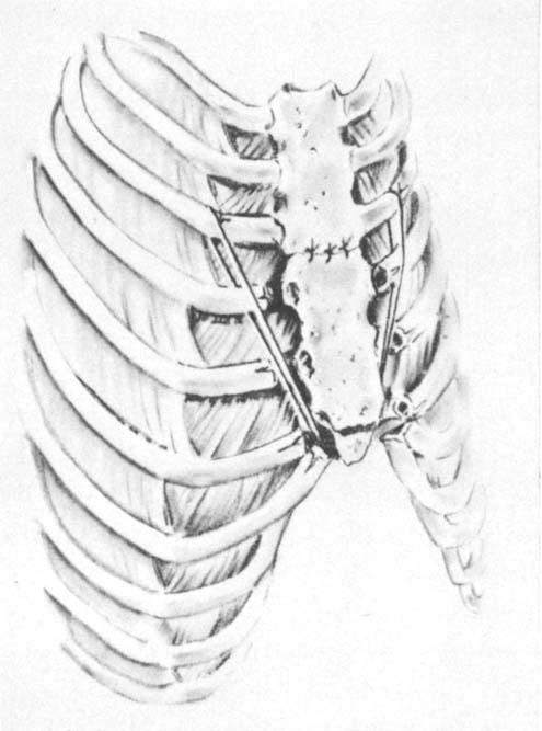 Pectus Excavatum and Carinaturn, FIG. 2. Operative repair of symmetrical pectus excavatum. The involved cartilages are resected, and the corrected position of the sternum i.