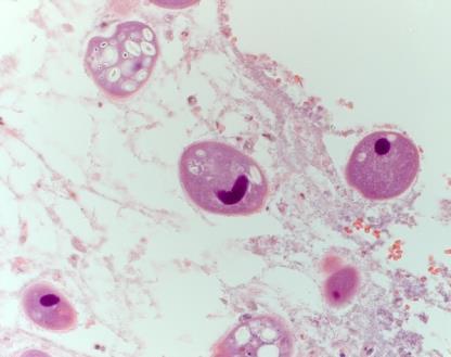 6) Balantidium sp. Balantidium sp. from the GI tract of a pig. H & E stained section of pig lumen.