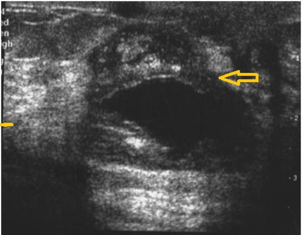 Fig. 7: A case of peri ductal mastitis showing a dilated, thick walled retroareolar duct with retained secretions (A).