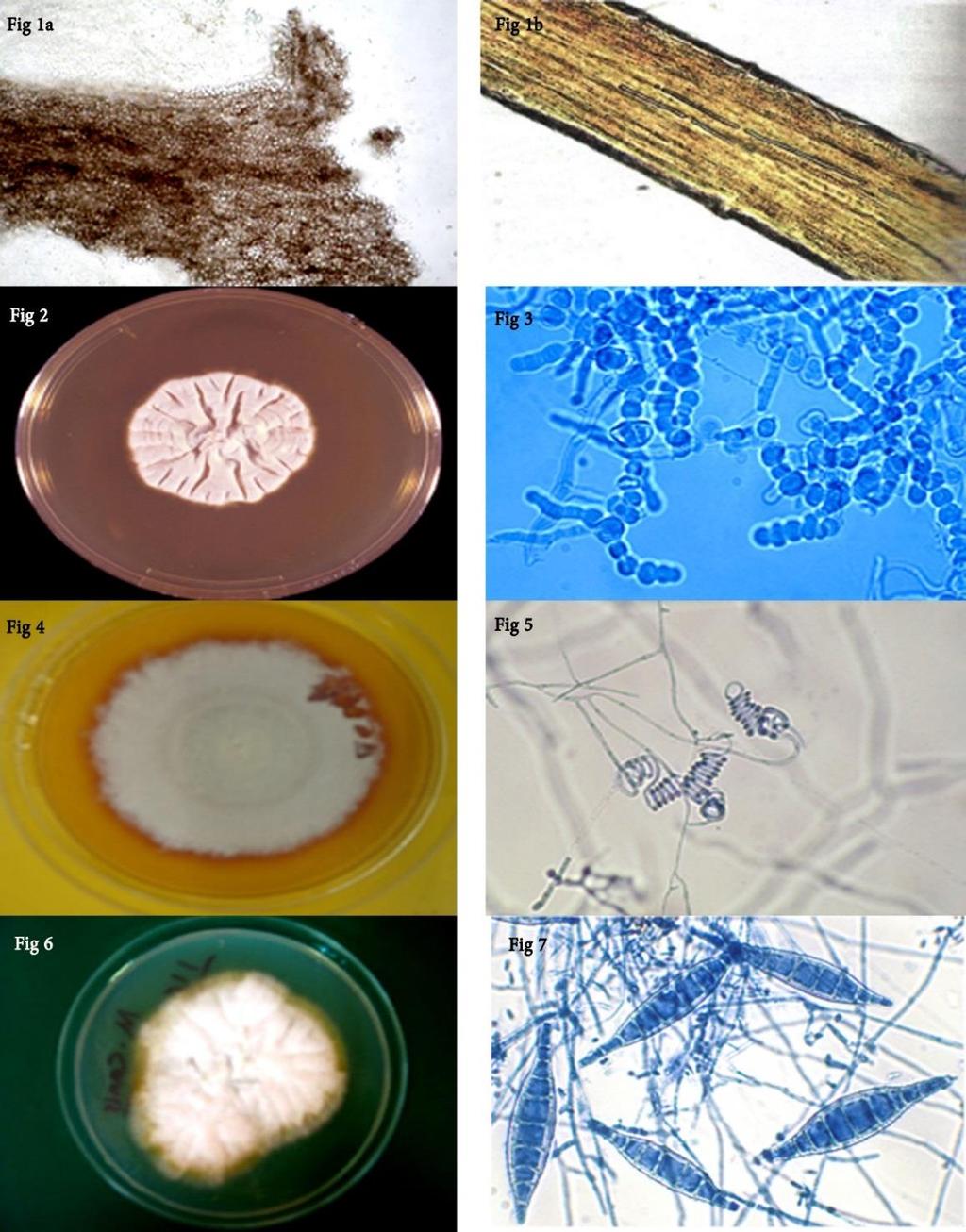 Fig 1a. arthrospores outside the hair (Ectothrix). Fig 1b. arthrospores inside the hair shaft (Endothrix). Fig 2. T.