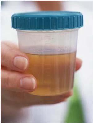 What Causes Changes in Urine Color or Odor?