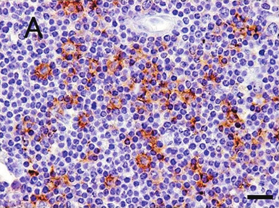 Immunohistochemical examination showed that neoplastic cells were positive for BLA-36 (Biogenex Laboratories, California, USA) and negative for CD3 (Biogenex Laboratories) (Fig. 4).
