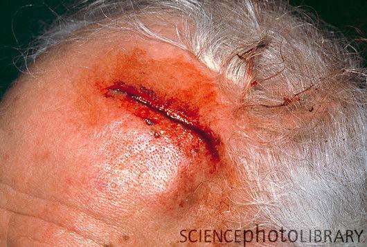 Most common area of lacerations Scalp & Face: 51% Upper extremities: 34% (i.e. fingers) Lower extremities: 13% (i.