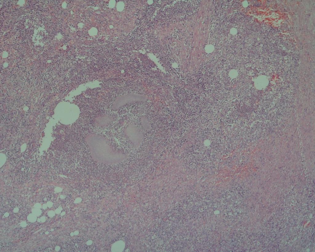 Large fungal mats were noted in the histology sections of the omental nodules Fig 4.