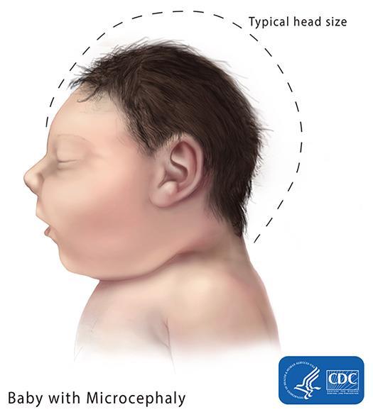 Microcephaly Microcephaly in association with Zika: Microcephaly is a birth defect where a baby s head is much smaller than expected when compared to babies of the same sex and age Babies with