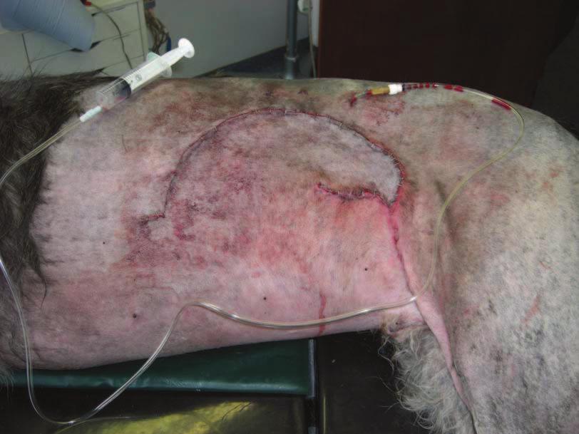 SURGICAL PROCEDURE Ten days post initial presentation the wound bed allowed closure. The vast skin deficit was closed using a sub-dermal plexus rotational skin flap.