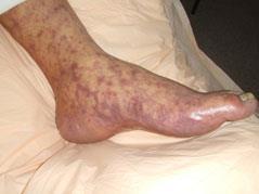 Rocky Mountain Spotted Fever Agent: Rickettsia rickettsii Infects endothelial cells Clinical Signs acute signs seen 2-14 days after bite Acute fever, headache, myalgia,