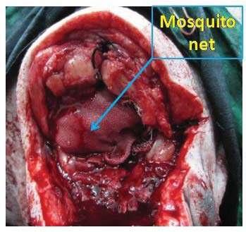 hernia using sterilized nylon mosquito