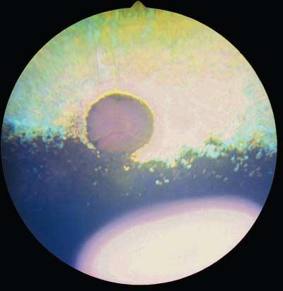 adjacent corneal opacity (not visible in this photograph). Figure 2.