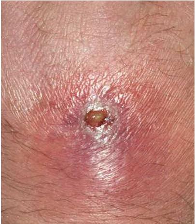 Schwartz, MD Assistant Clinical Professor UCSF, Division of Infectious Diseases 32 y/o M with 3 days of an enlarging, painful lesion on his L thigh that he