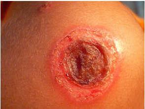 aureus, Group A strep Treatment: Few lesions (topical = systemic) Mupirocin or Retapamulin ointment Multiple lesions (systemic