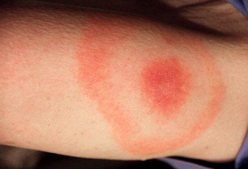 Erythema chronicum migrans, usu at ~ 4 wks Constitutional symptoms in up to ~50%