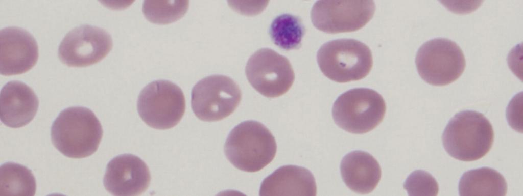 B. microti on Blood Smear Babesiosis Indications for Treatment Positive DNA test or blood smear and: Symptomatic
