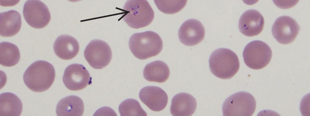 Babesiosis - Treatment Severity Treatment Length Comments Mild azithromycin 500mg/d on day 1; 250mg/d day from day