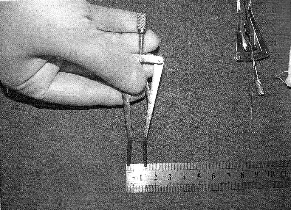 A specially marked (in mm) stainless steel rod (2 mm diameter), was used to measure the site of the opening from the anterior nasal spine (this is the fixed bony point nearest to the opening, taken