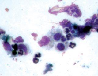 Starting with the lowest magnification, choose an area that shows abundant purple staining (indicating the presence of inflammatory cells and/or organisms) then select a lens of higher magnification.