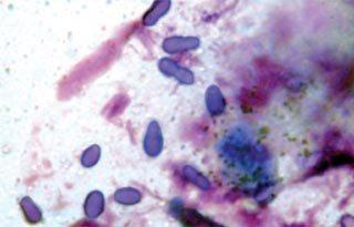 You should expect to find keratinocytes on cytology, but any other cell type indicates a disease process.