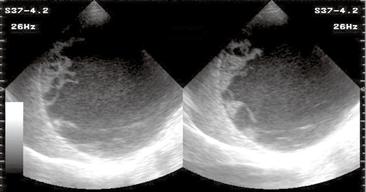 A small air lucency was also seen in the superior portion of this opacity (air crescent sign). Axial CT of this lesion (Fig. 2a) showed this mass to be of low density.