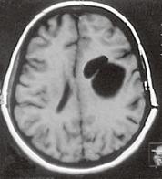 encountered anywhere in the body. Fig. 15a-d Disseminated hydatid disease.